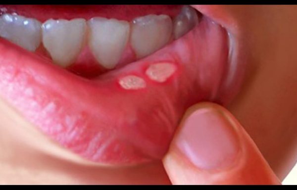 Mouth Ulcers and Sore Gums