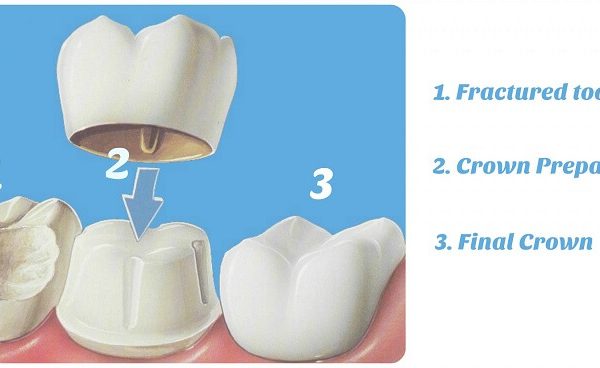 Broken Tooth, Lost fillings, Loose Crowns